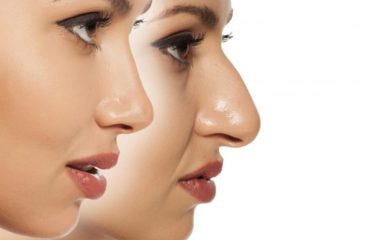 non surgical nose job