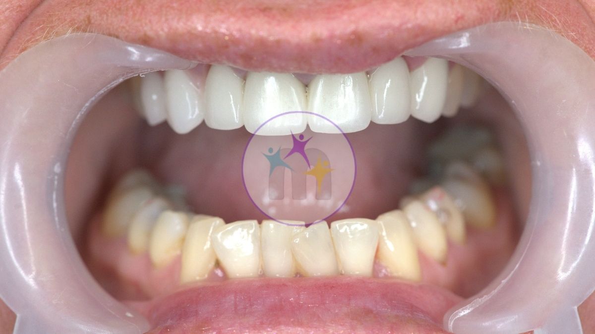 medicotrips after implants medicotrips after implants