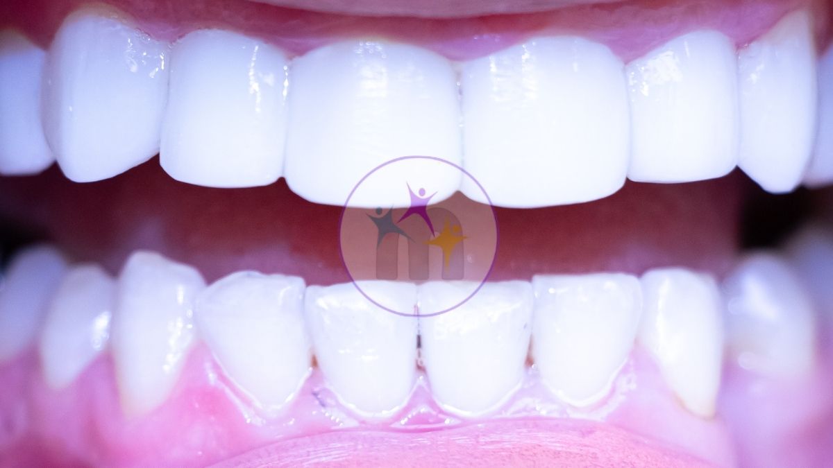 medicotrips after veneers