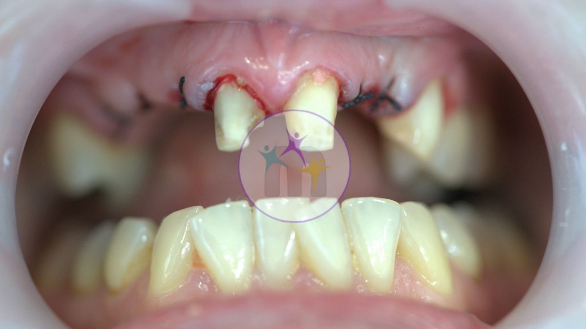 medicotrips before implants medicotrips before implants