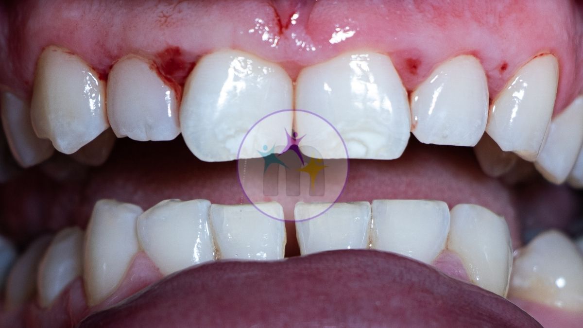 medicotrips before veneers
