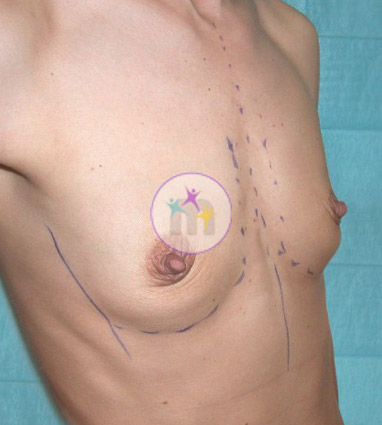 Breast Uplift2 1