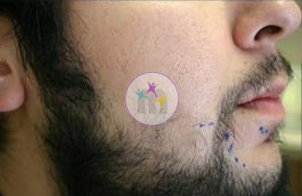 beard 3 1