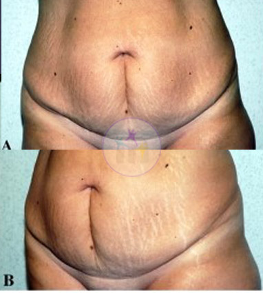 Abdominoplasty1 1 Abdominoplasty1 1