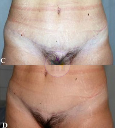 Abdominoplasty1 2 Abdominoplasty1 2