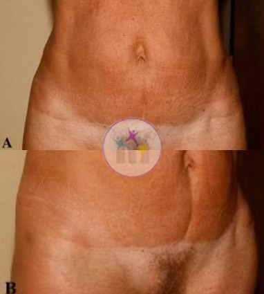 Abdominoplasty2 1 Abdominoplasty2 1