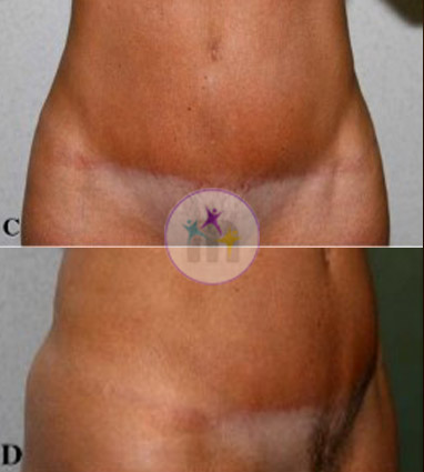 Abdominoplasty2 2 Abdominoplasty2 2