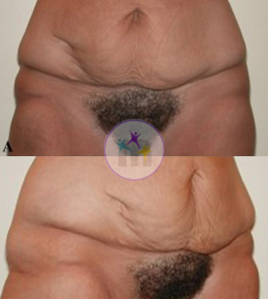Abdominoplasty3 1 Abdominoplasty3 1