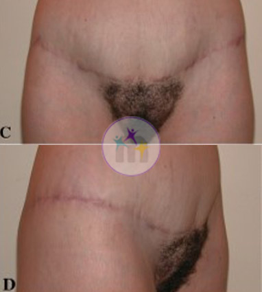 Abdominoplasty3 2 Abdominoplasty3 2