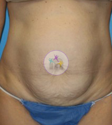 Abdominoplasty4 1 Abdominoplasty4 1