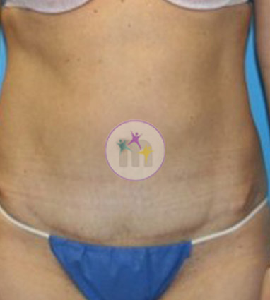 Abdominoplasty4 2 Abdominoplasty4 2