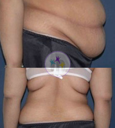 Abdominoplasty5 1 Abdominoplasty5 1