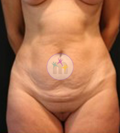 Abdominoplasty6 1 Abdominoplasty6 1
