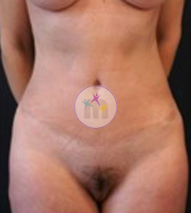Abdominoplasty6 2 Abdominoplasty6 2