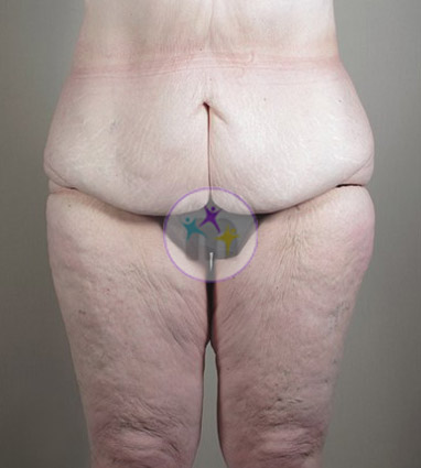 Abdominoplasty8 1 Abdominoplasty8 1