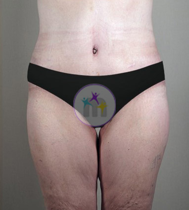 Abdominoplasty8 2 Abdominoplasty8 2