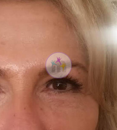 Blepharoplasty 2