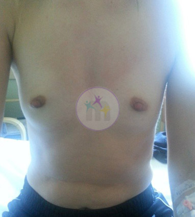 Breast Uplift3 1