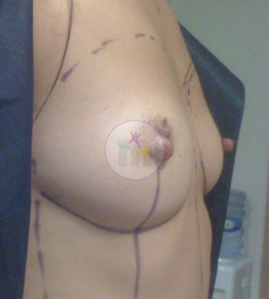 Breast Uplift4 1