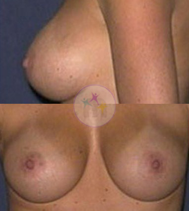 Breast Uplift5 2