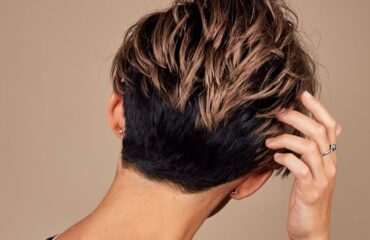 Hair transplant Before After