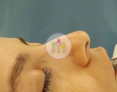 Rhinoplasty4 1
