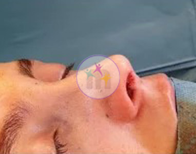 Rhinoplasty4 2