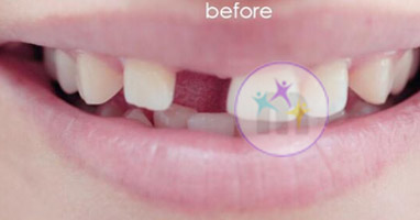 dental implant 6 1jpg dental implant 6 1jpg