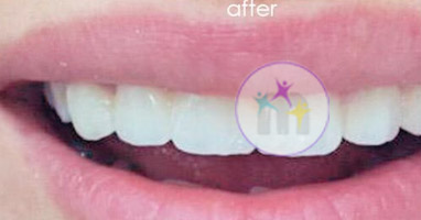 dental implant 6 2 dental implant 6 2