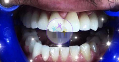 dental implant 7 2 dental implant 7 2