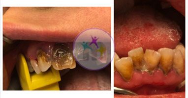 dental implant 8 1 dental implant 8 1