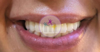 dental implant 8 2 dental implant 8 2