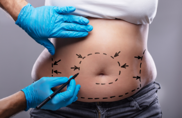 Liposuction